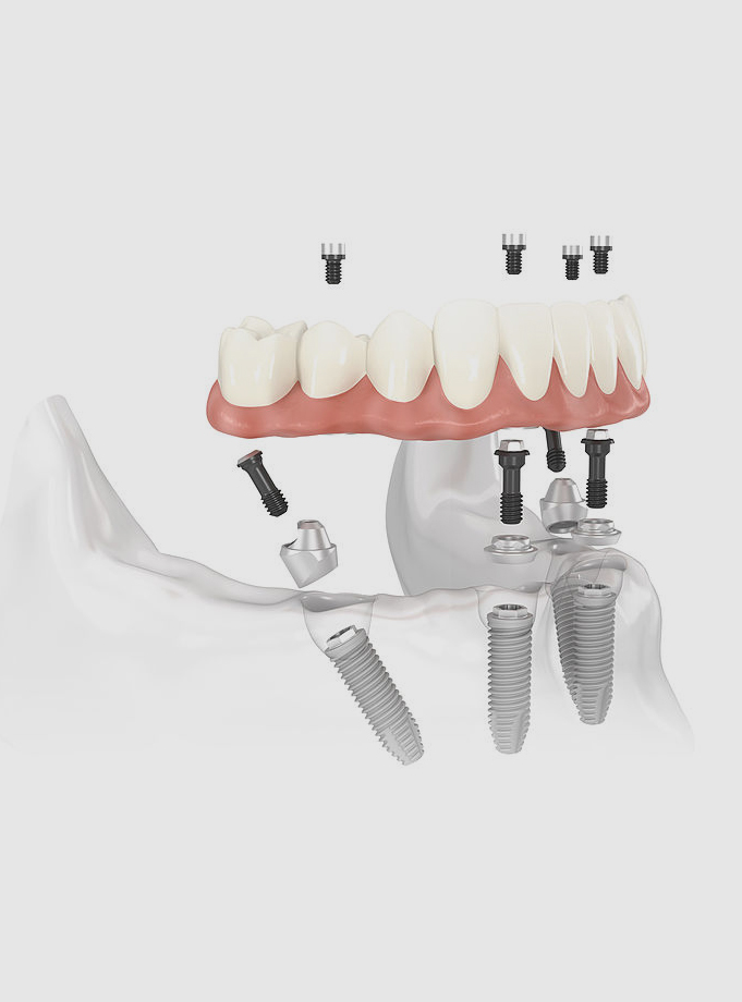 Full Mouth Implants